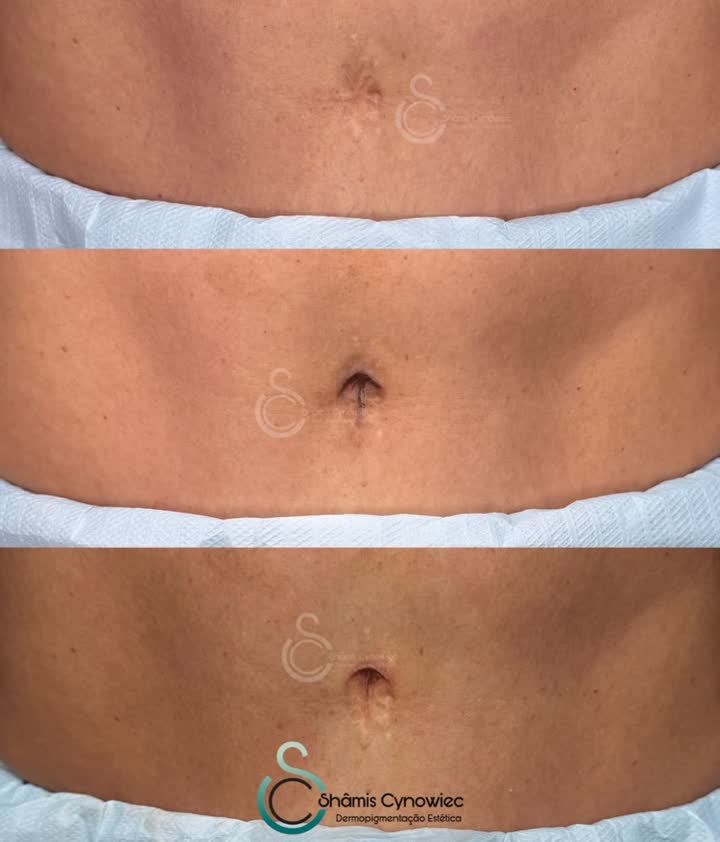 Belly Button Reconstruction